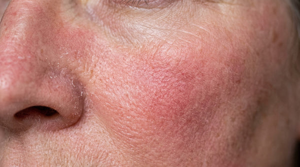 Damaged Skin Barrier: Six Signs and the Two-Week Repair