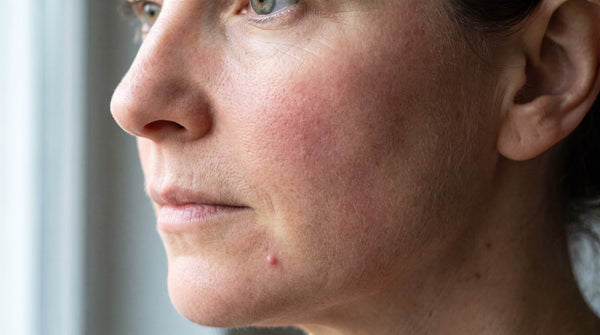 Does Beef Tallow Clog Pores? The Comedogenic Question, Answered
